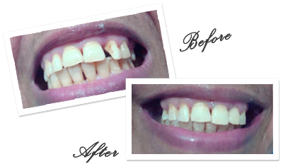 Dentist in Goa for Cosmetic Dental Bonding in Goa