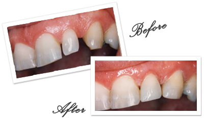 Cosmetic Dental Bonding in Goa