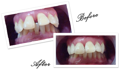 Goa Dentist for Composite Veneers