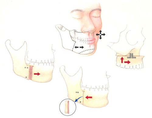 Orthognathic surgery in Goa