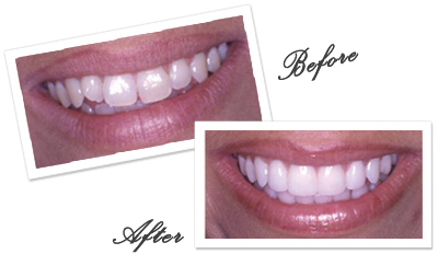 Goa Dentist for smile makeover in Goa