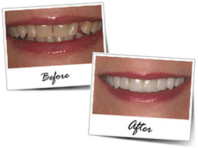 Smile Makeover in Goa