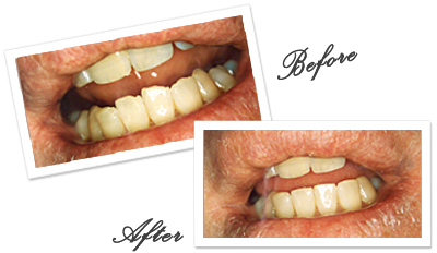 Teeth Contouring in Goa